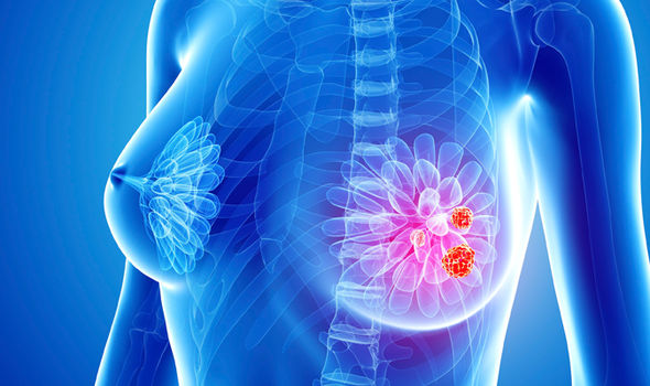 ung-thu-vu-2-1783071418120330668341 4 dấu hiệu bất thường cảnh báo ung thư vú - Ảnh 1.