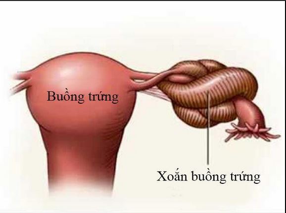 Xoắn U Nang Buồng Trứng: Cảnh Báo Đau Bụng Và Buồn Nôn Nguy Hiểm