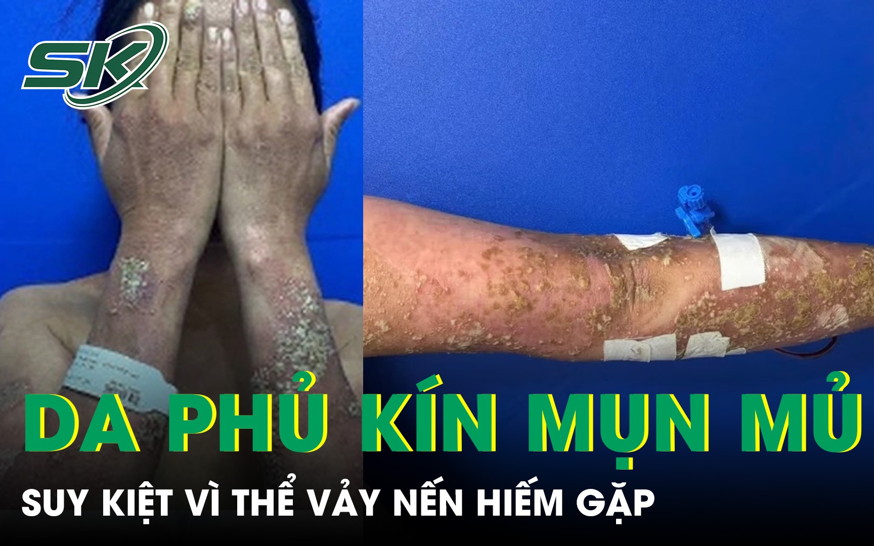 Nguy cơ tổn thương da nghiêm trọng khi tự ý điều trị vảy nến