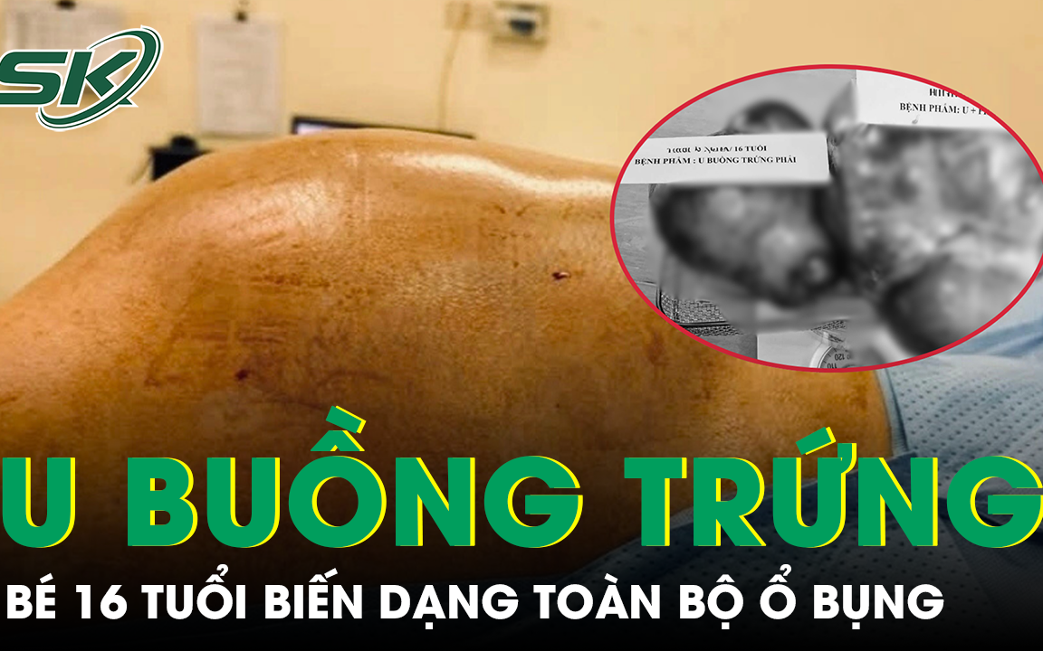 Những Dấu Hiệu Cảnh Báo Khối U Buồng Trứng Ở Thanh Thiếu Niên