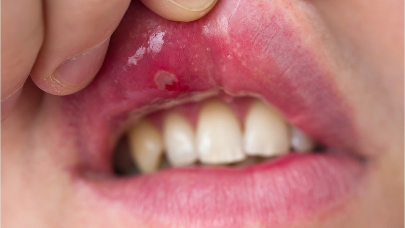 Bệnh nhân mắc Lupus ban đỏ Bệnh nhân mắc Lupus ban đỏ