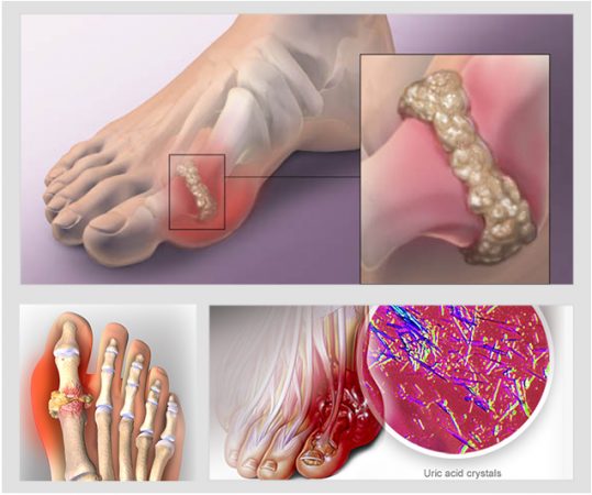 Tác Động Của Axit Uric Đến Sức Khỏe Nam Giới: Bí Ẩn Cần Khám Phá