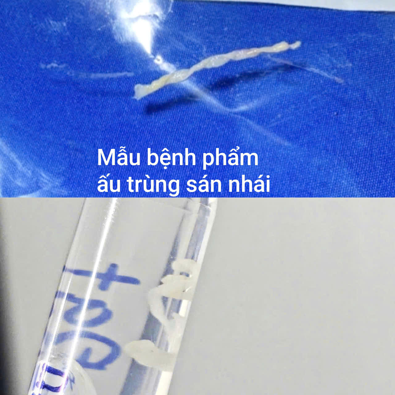 au-trung-san-nhai-17866090457232125237772 Cảnh Giác Khi Uống Nước Suối: Nguy Cơ Tiềm Ẩn Từ Ký Sinh Trùng - Ảnh 2.