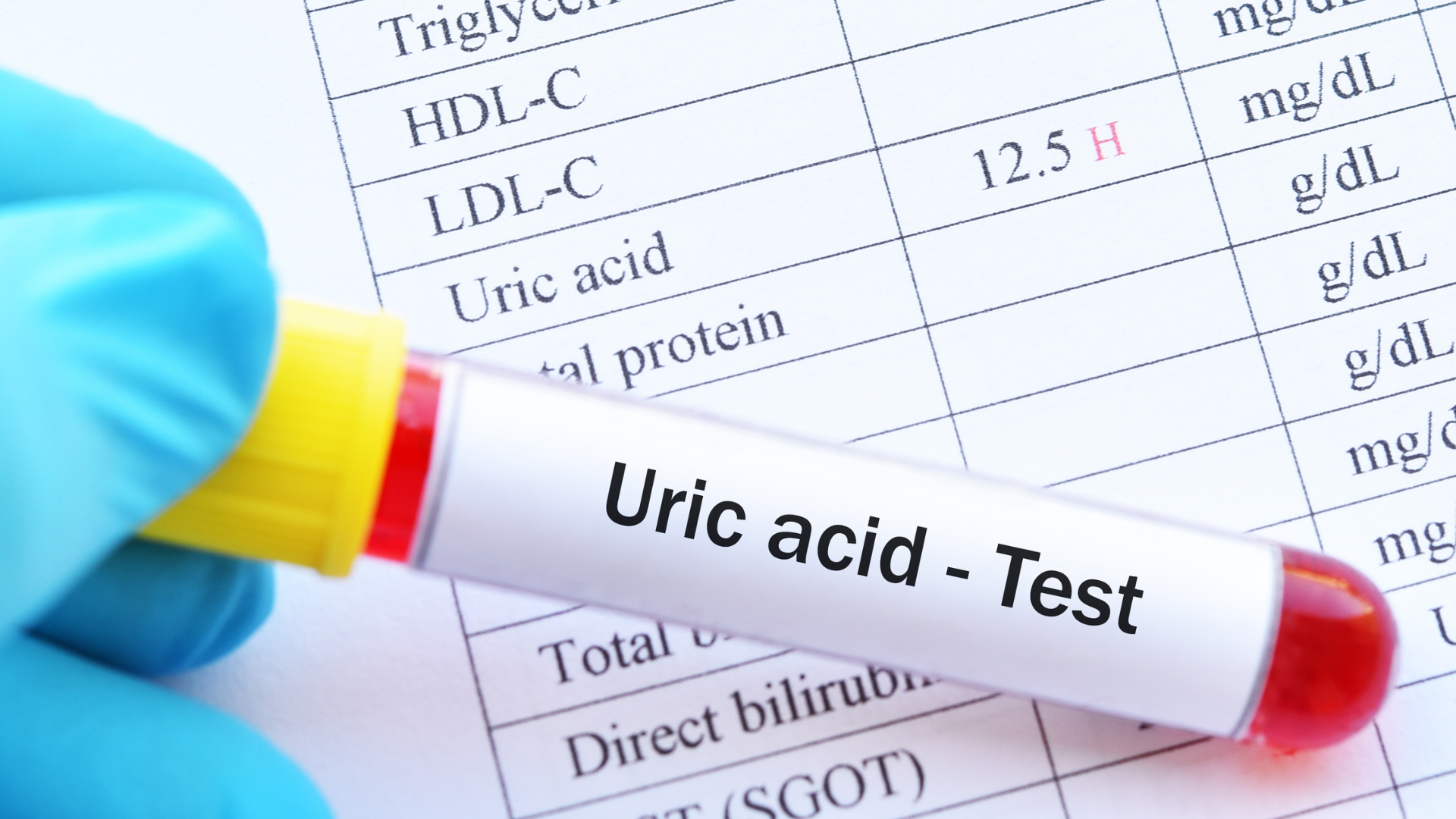 Tác động của axit uric đối với sức khỏe nam giới 1 Tác động của axit uric đối với sức khỏe nam giới 1