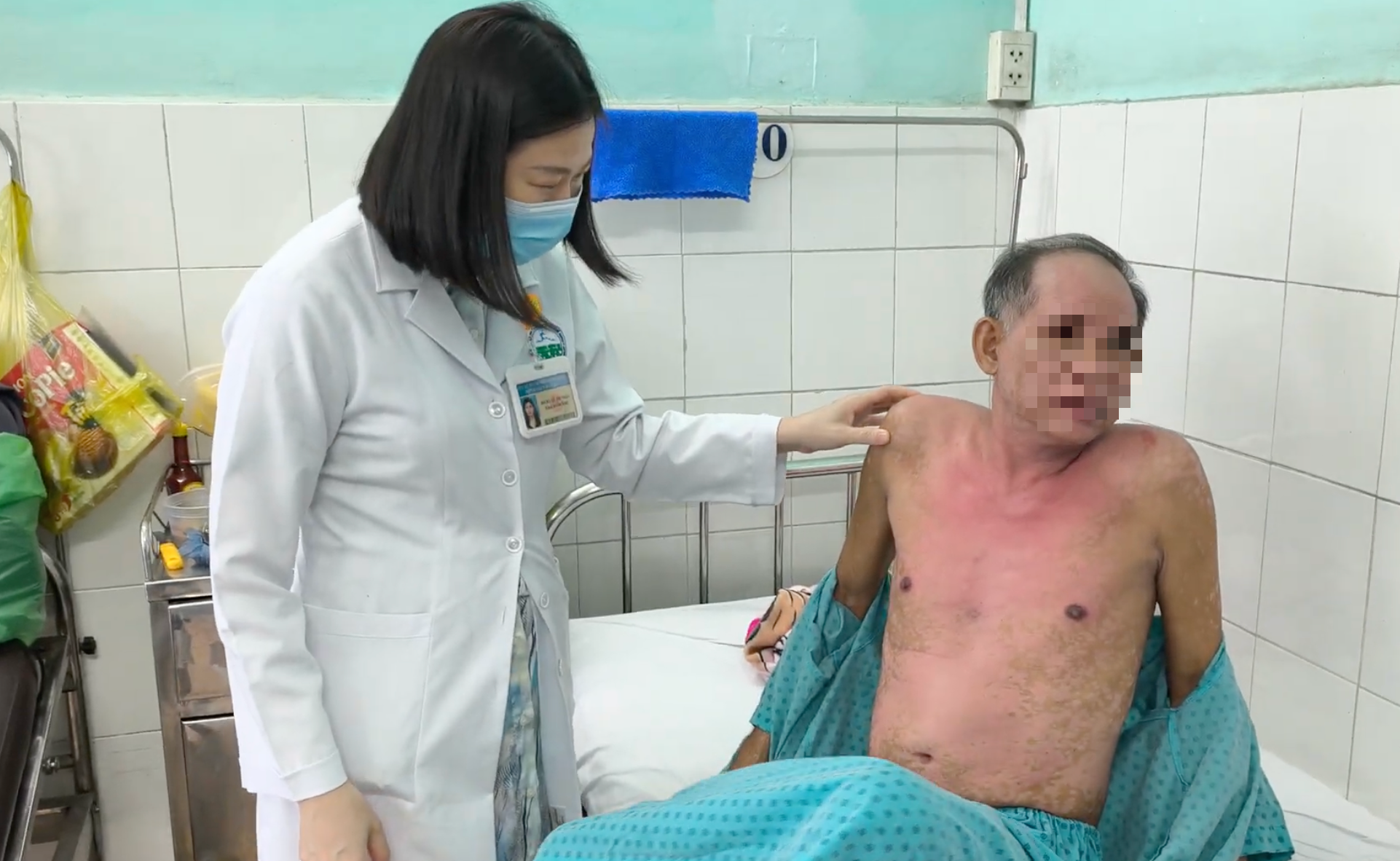 Cảnh Báo Từ Trường Hợp Dị Ứng Nghiêm Trọng Với Thuốc Nhỏ Mắt
