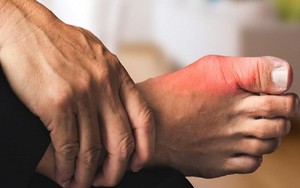 Cách Chạy Bộ An Toàn và Hiệu Quả Cho Người Bị Gout
