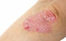 Tầm Quan Trọng của Xét Nghiệm ctDNA Trong Quyết Định Hóa Trị Sau Mổ Ung Thư Đại Tràng