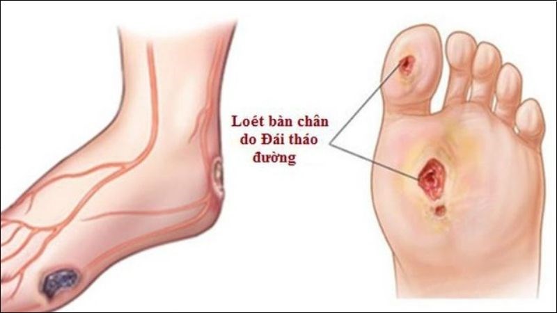Cảnh Giác Với Tê Rần Ở Bàn Chân: Tình Trạng Cho Người Bị Đái Tháo Đường