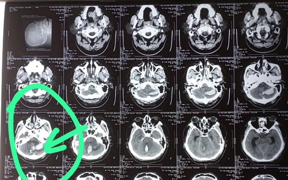 Hành Trình Tìm Lại Chân cho Người Mẹ Lào Sau 8 Tháng Liệt Giường