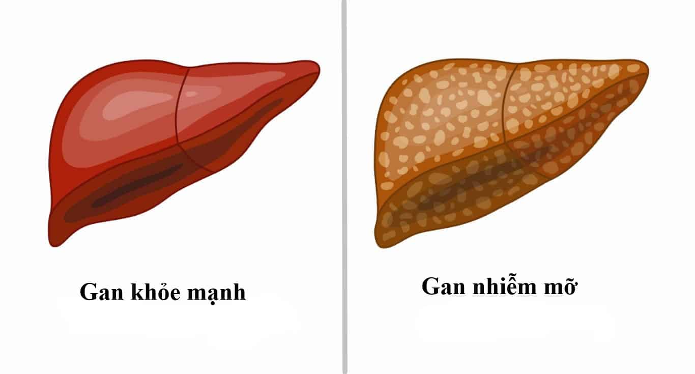 gan-nhiem-mo-17857546508221647976484 Gan nhiễm mỡ: Nguyên nhân và dấu hiệu - Ảnh 1.