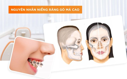 Giải Quyết Vấn Đề Hóp Má Khi Niềng Răng: Nguyên Nhân và Biện Pháp Hiệu Quả