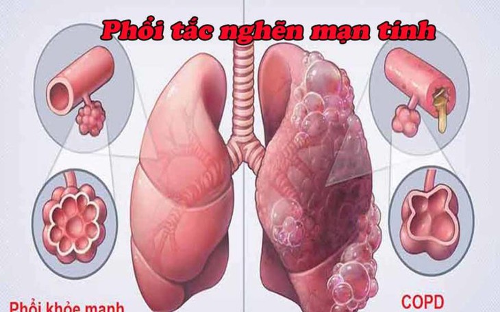 Nhận biết bệnh phổi tắc nghẽn mạn tính