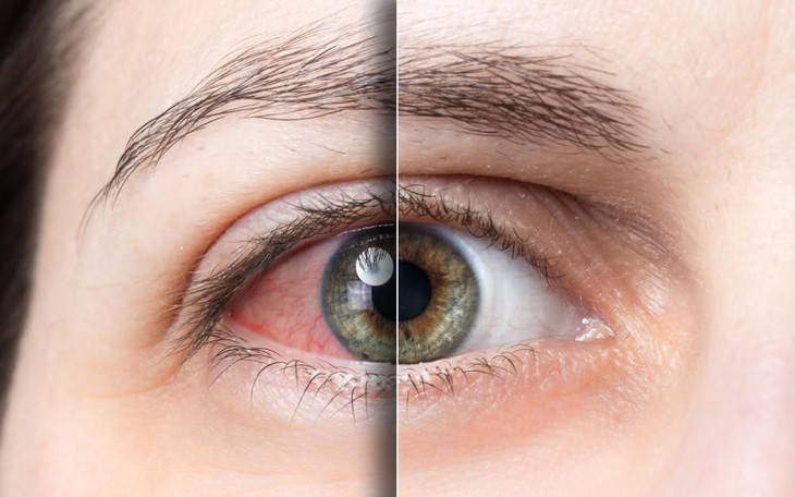 Khô Mắt: Nguyên Nhân, Triệu Chứng và Những Nguy Cơ Tiềm Ẩn