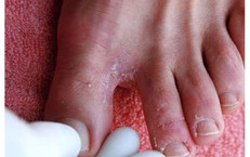 Vai Trò Của Vaccine HPV Trong Việc Bảo Vệ Sức Khỏe Trẻ Em