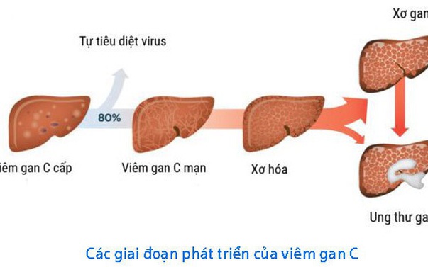 Giải Pháp Đột Phá Hướng Tới Loại Trừ Viêm Gan vào Năm 2030
