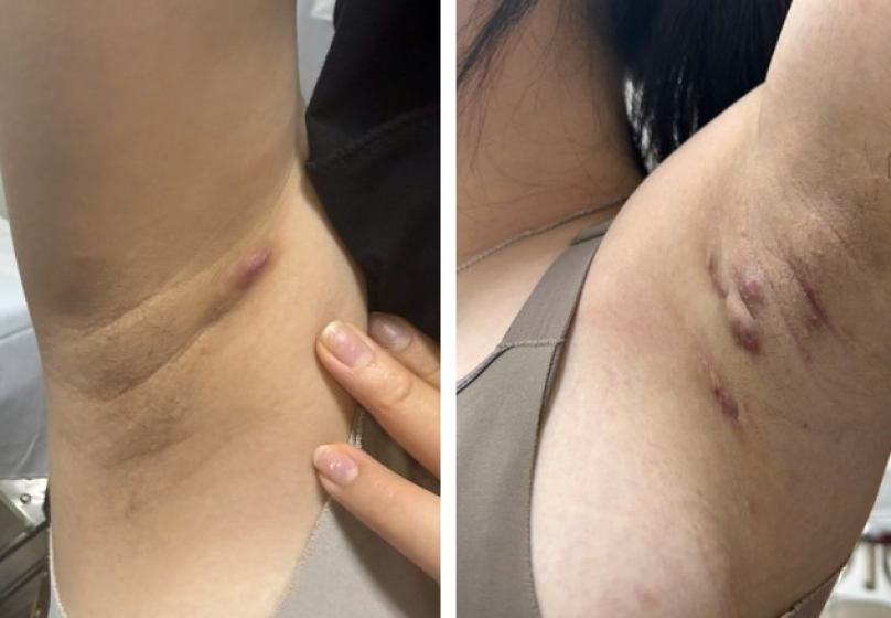 Viêm tuyến mồ hôi mủ dễ nhầm với mụn nhọt, áp xe