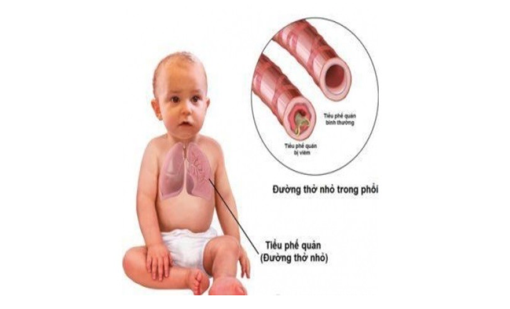 Đối Phó Với Viêm Tiểu Phế Quản Cấp Ở Trẻ Nhỏ: Những Điều Cha Mẹ Cần Biết