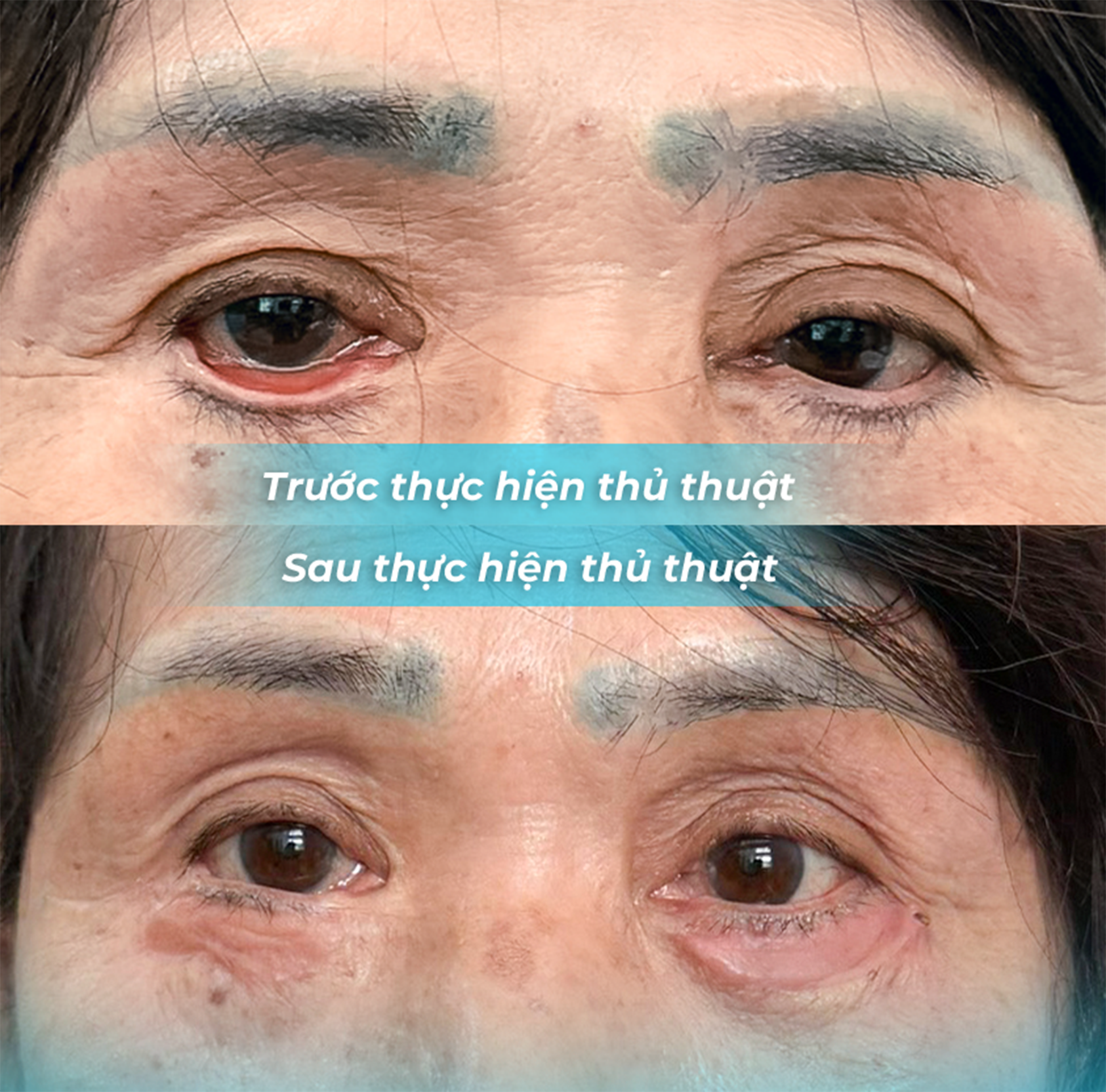 Nguy Cơ Tai Biến Sau Phẫu Thuật Thẩm Mỹ: Câu Chuyện Của Một Bệnh Nhân