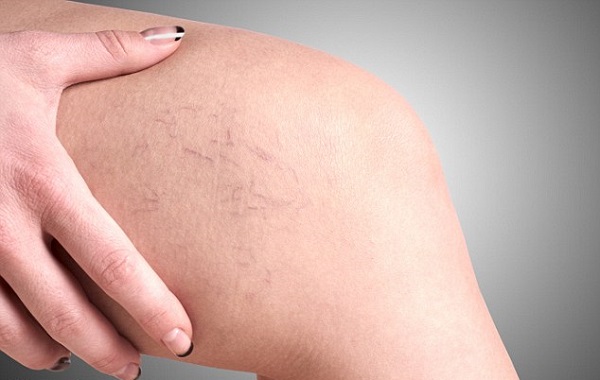 Những Biến Chứng Nguy Hiểm Của Suy Giãn Tĩnh Mạch Chân Mà Bạn Cần Biết