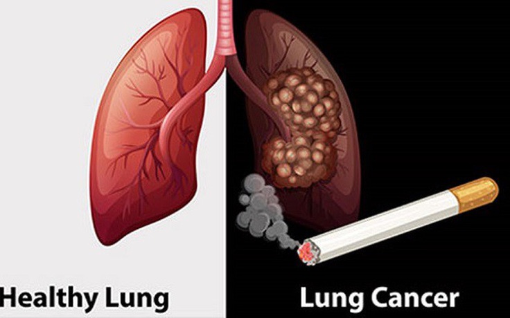 Tình Trạng Chẩn Đoán Muộn Ung Thư Phổi Tại Việt Nam: Nguyên Nhân và Giải Pháp