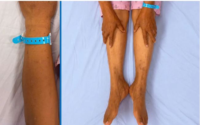 Nhận Biết 7 Dấu Hiệu Tổn Thương Gan Để Bảo Vệ Sức Khỏe