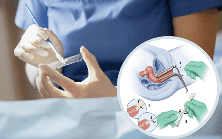 Cách phát hiện ung thư cổ tử cung ở giai đoạn tiền ung thư - Ảnh 2.