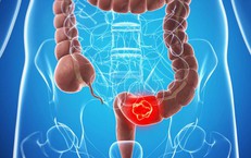 Giải Quyết Vấn Đề Bí Tiểu Ở Người Cao Tuổi: Hướng Dẫn Chi Tiết