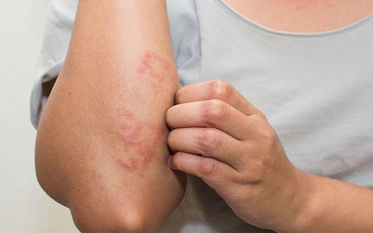 7 Thói Quen Vàng Để Quản Lý Viêm Da Cơ Địa Hiệu Quả- Ảnh 1.