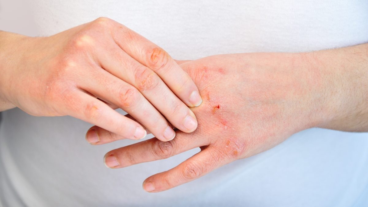 7 Thói Quen Vàng Để Quản Lý Viêm Da Cơ Địa Hiệu Quả- Ảnh 2.
