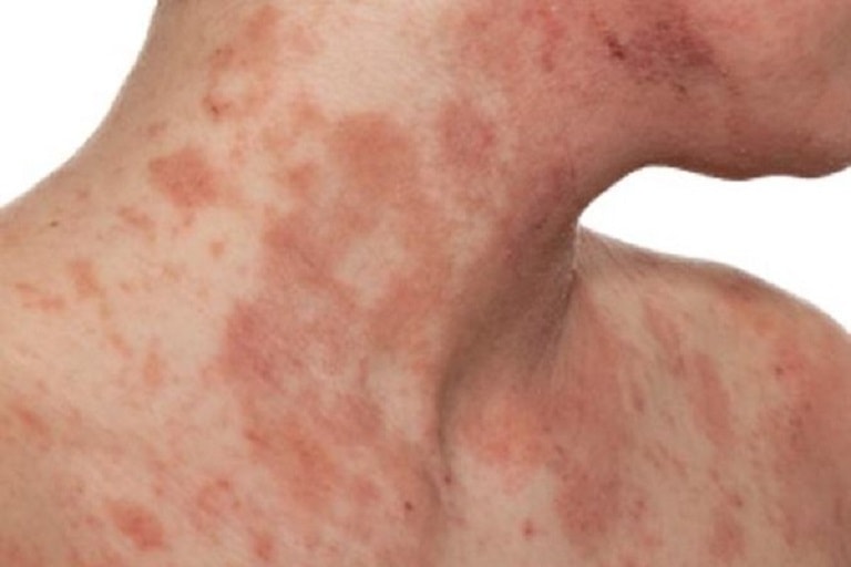 Viêm da cơ địa thường ảnh hưởng đến giấc ngủ và sinh hoạt