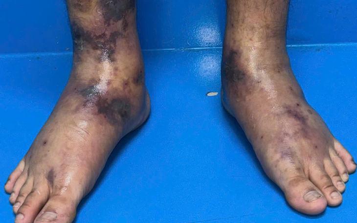 Cứu sống cụ bà có mỡ máu tăng vọt, huyết tương đục như sữa- Ảnh 4.