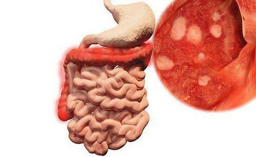 Viêm Ruột: Tác Động và Cách Bảo Vệ Sức Khỏe Tiêu Hóa