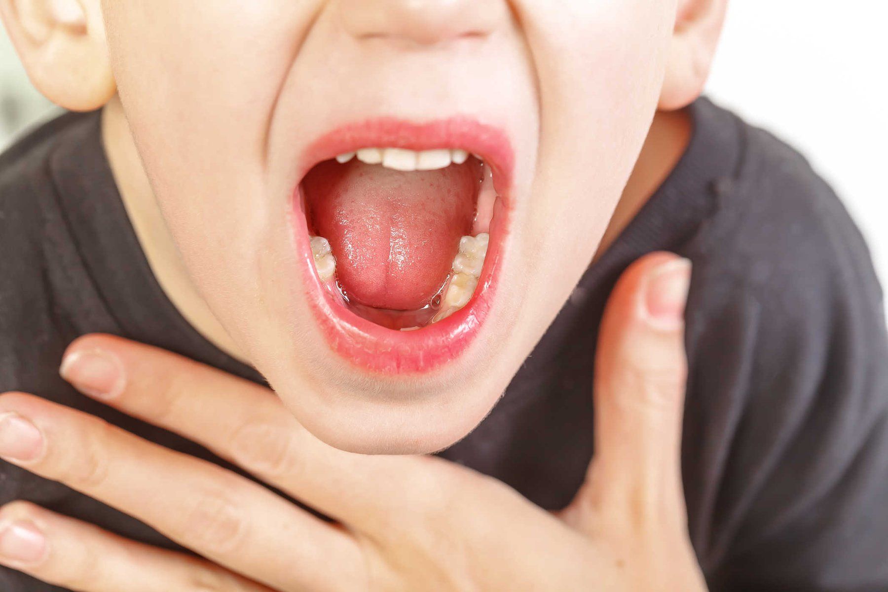 Hiểu Biết Về Viêm VA: Triệu Chứng và Biến Chứng Ở Trẻ Em