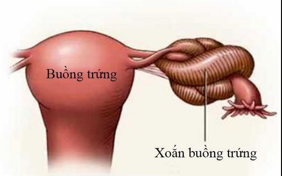 Làm Thế Nào Để Điều Trị U Nang Buồng Trứng Ác Tính Hiệu Quả?