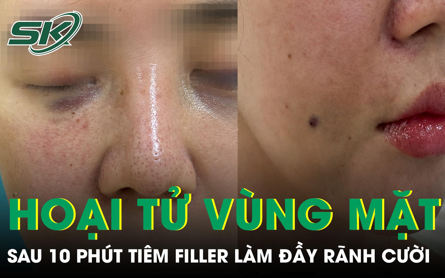 Cô gái 29 tuổi hoại tử vùng mặt sau 10 phút tiêm filler làm đầy rãnh cười