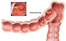 Yếu tố nguy cơ Alzheimer: nhận diện sớm và cách giảm thiểu
