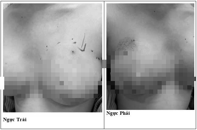 Hình ảnh tổn thương ở ngực bệnh nhân. Ảnh: BVCC