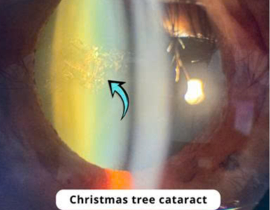 Phát hiện bệnh hiếm hình 'cây thông Noel' trong mắt người phụ nữ 70 tuổi- Ảnh 2.
