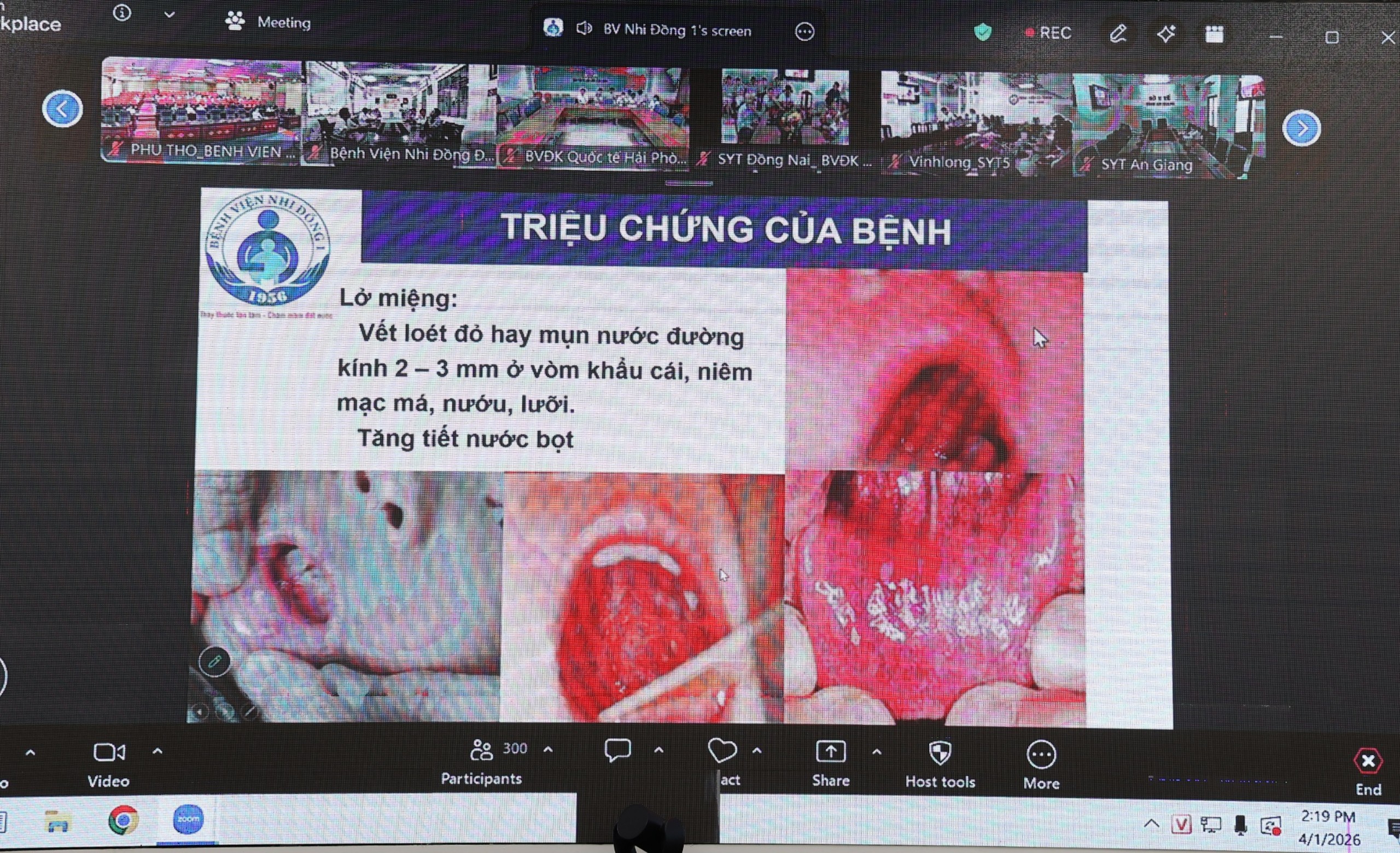 tay-chan-mieng-kcb-1775034493477240989775 Đã có gần 100.000 ca tay chân miệng, Bộ Y tế nhắc phải phòng chống từ nhàtrường - Ảnh 1.