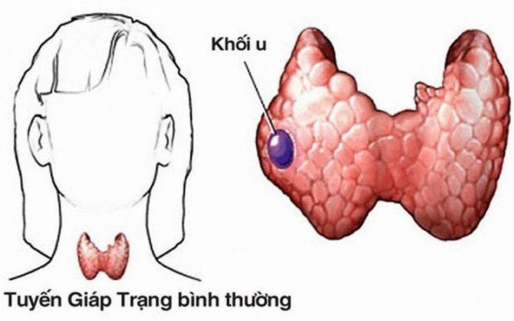 Tiểu đường có làm tăng nguy cơ ung thư tuyến giáp?- Ảnh 1.